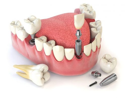 Avant d’effectuer la pose d’implant dentaire, n’hésitez pas à faire quelques vérifications, notamment concernant le remboursement